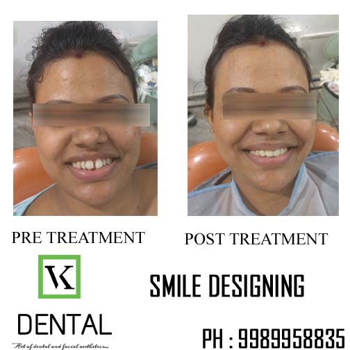 SMILE DESIGNING